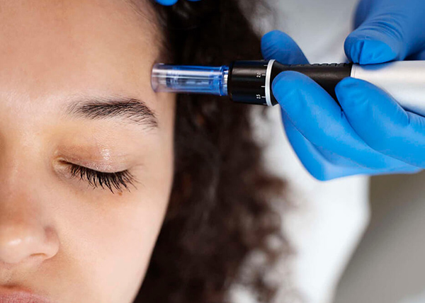 Microneedling-most-popular-services-scaled